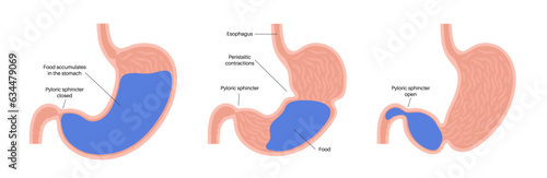 Gastroparesis anatomical poster