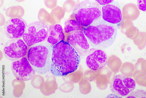 Chronic myeloid leukemia cells or CML, analyze by microscope