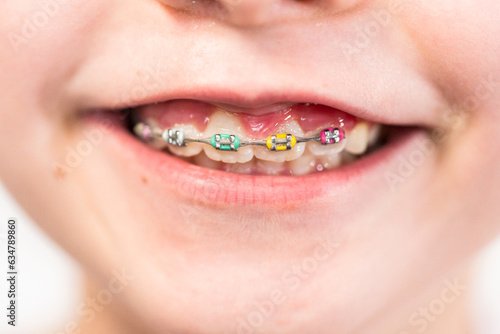 Little girl with rainbow braces