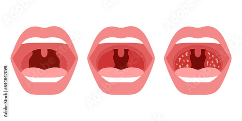 Open mouth with health and sick throat of human. Comparison healthy throat, tonsillitis bacterial and viral. Infection, redness of tonsils. Inflammation and pain airway. Vector photo