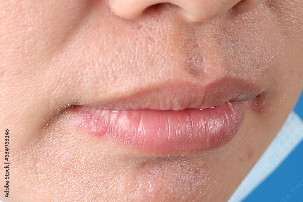 Angular Cheilitis close up of a woman with a smile Angular Cheilitis close up of a woman with a smile