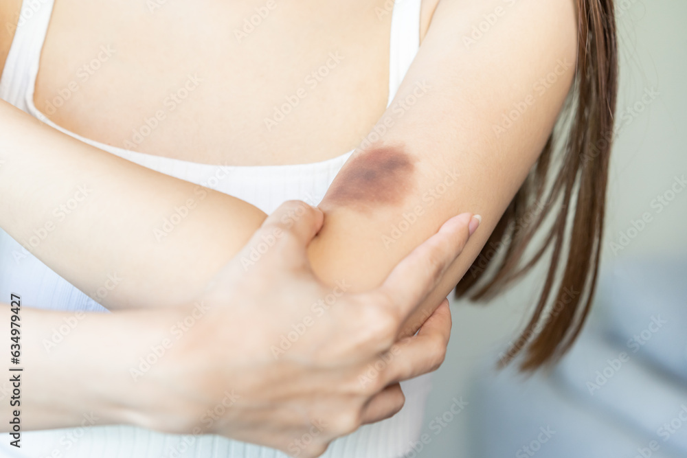 Close up of stain bruise wound on her arm, contusion asian young woman, girl an accident fell down stairs at home, hand in healing injury by massage hematoma blood. Extravasation blue, purple on skin.