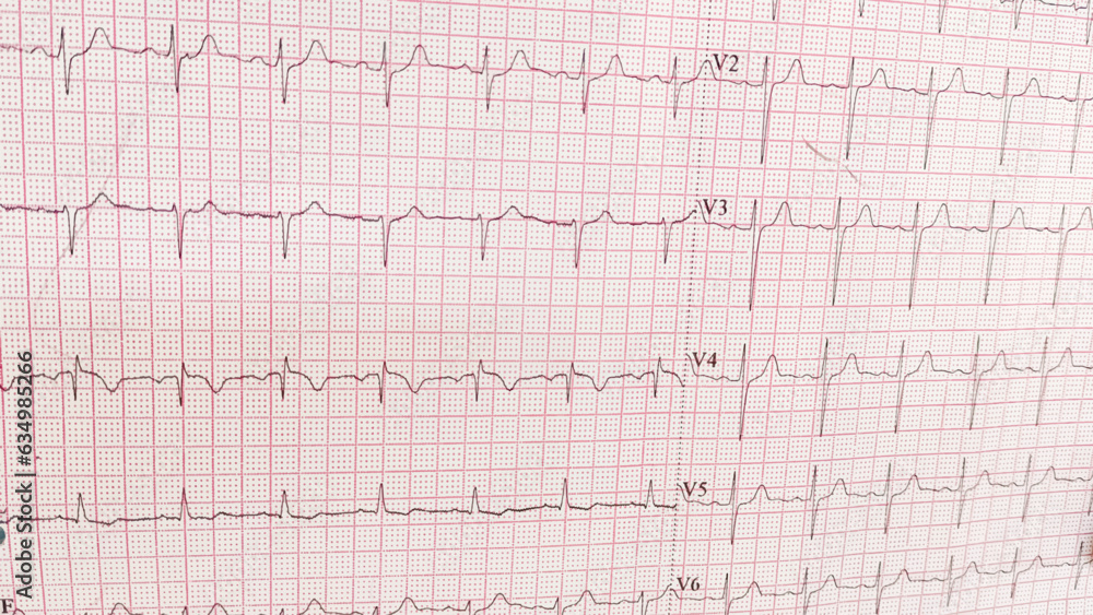 ECG pulse rate paper that shows sinus rhythm abnormality of right ventricular hypertrophy. Cardiac fibrillation. Normal sinus rhythm ECG. Vital sign. Medical healthcare symbol. ECG pulse rate paper that shows sinus rhythm abnormality of right ventricular hypertrophy. Cardiac fibrillation. Normal sinus rhythm ECG. Vital sign. Medical healthcare symbol.
