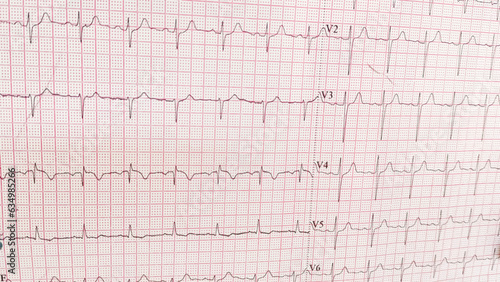 ECG pulse rate paper that shows sinus rhythm abnormality of right ventricular hypertrophy. Cardiac fibrillation. Normal sinus rhythm ECG. Vital sign. Medical healthcare symbol.