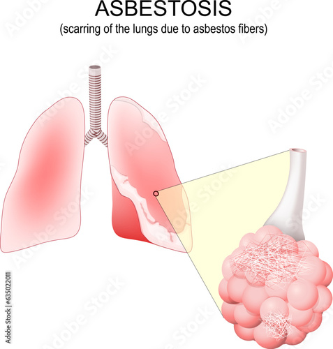 Asbestosis lungs. Close-up of alveolus with asbestos fibers.