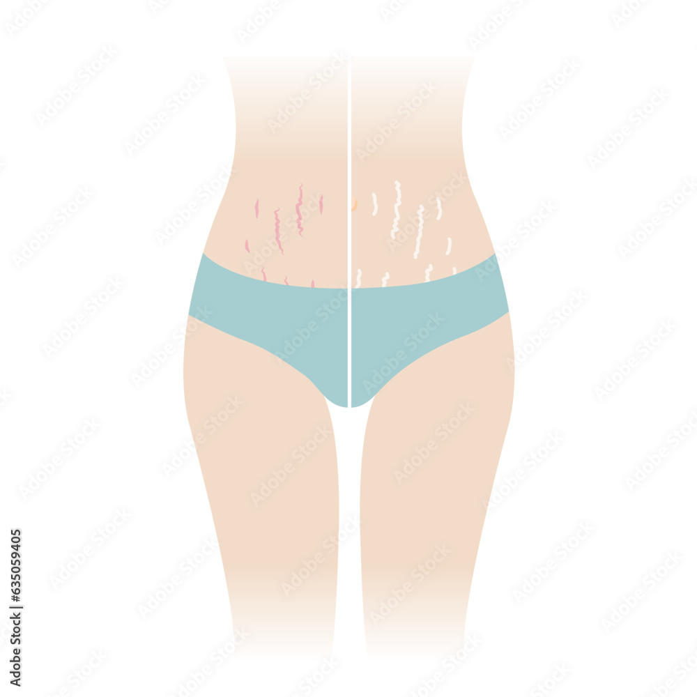 Comparison of red and white stretch marks on tummy vector illustration isolated on white background. The striae rubrae and striae albae appear on the abdomen, mid stomach, belly front of woman body.