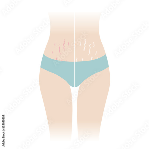 Comparison of red and white stretch marks on tummy vector illustration isolated on white background. The striae rubrae and striae albae appear on the abdomen, mid stomach, belly front of woman body.