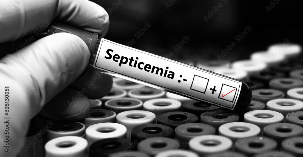Blood sample of patient positive test for septicemia. Photos | Adobe Stock