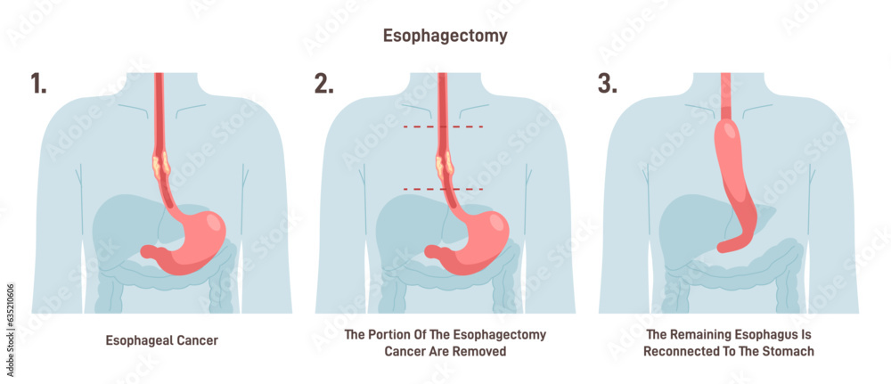 Esophagectomy. Partial Excision Of The Esophagus. Surgical Procedure ...