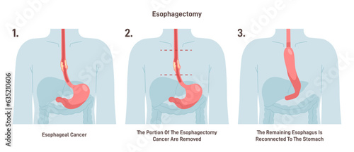 Esophagectomy. Partial excision of the esophagus. Surgical procedure photo