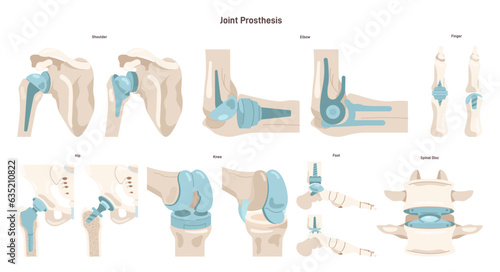 Joint implantation set. Injured or distracted human joint replaced