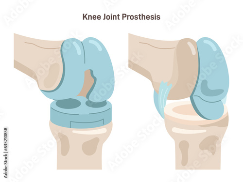 Joint implantation. Injured or distracted human joint replaced with artificial