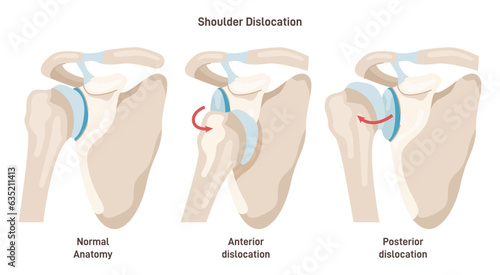 Shoulder dislocation types. Arm injury, upper arm bone pops out of the cup photo