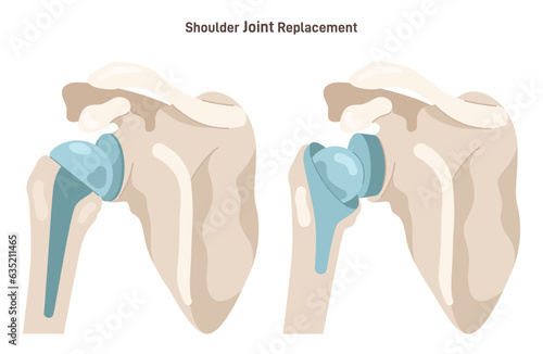 Joint implantation. Injured or distracted human joint replaced with artificial