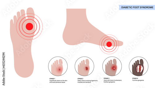 Diabetic Foot Ulcers