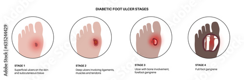 Diabetic Foot Ulcers