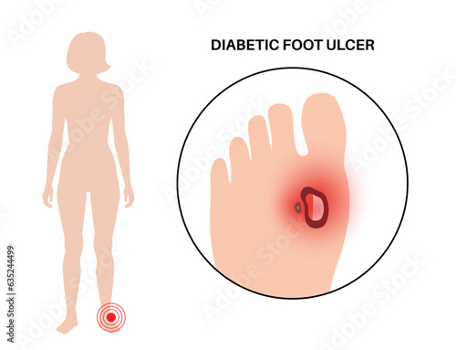 Diabetic foot syndrome