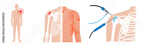 Shoulder arthroscopy poster