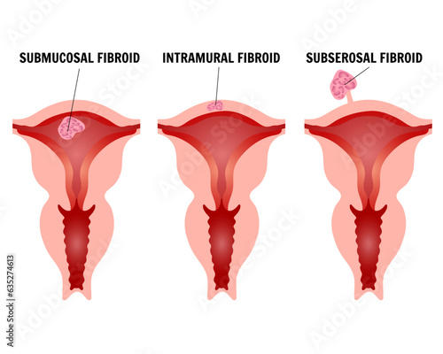 Medical infographic, types of uterine fibroids, subserosal fibroid, submucous fibroids, intramural fibroids