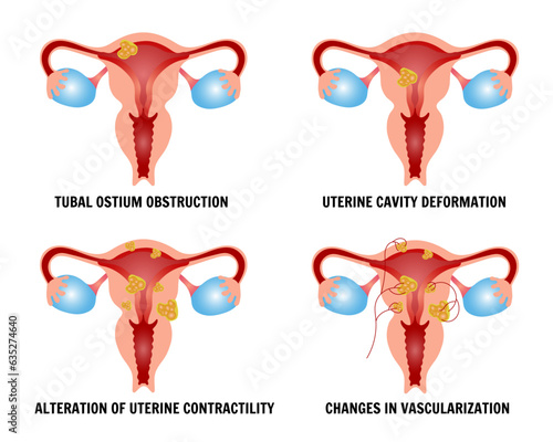 Medical infographic, gynecology disease, Tubal osmium obstruction, uterine cavity deformation, alteration of uterine contractility, changes in vascularization