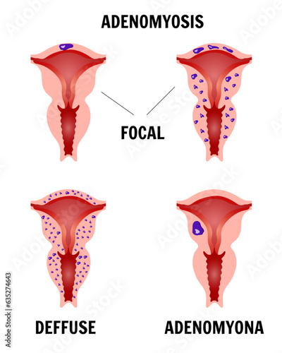 Medical infographic adenomyosis, focal, deffuse, adenomyona