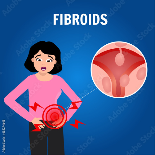 Medical infographic, women's health, types of uterine fibroids photo
