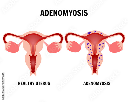 Medical infographic adenomyosis, healthy uterine and adenomyosis photo