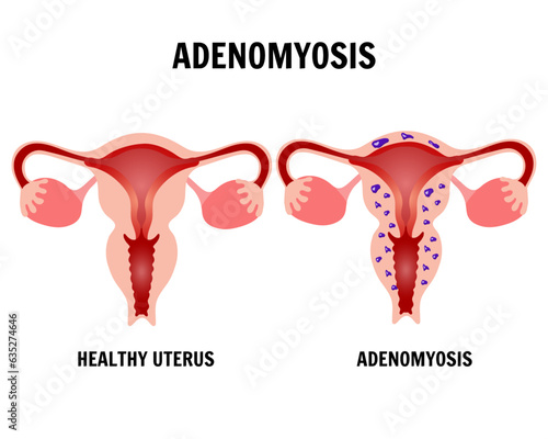 Medical infographic adenomyosis, healthy uterine and adenomyosis