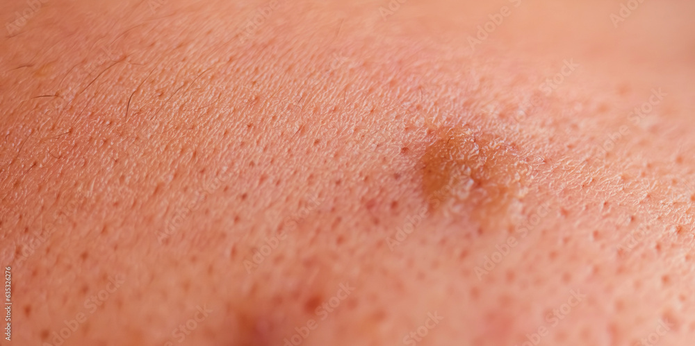 Rippled Texture Rash Allergic rash dermatitis skin texture. Problem skincare and health ...