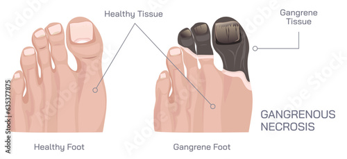 Healthy tissue and gangrene tissue. Gangrenous necrosis vector illustration. Foot gangrene image. amputated finger. Low Blood flow in the arteries. tissue death. Causes and symptoms. photo