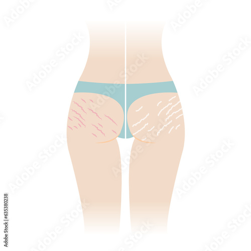 Comparison of red and white stretch marks on buttocks vector illustration isolated on white background. The striae rubrae and striae albae appear on the bottom, hip, ass back of woman body.