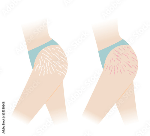 Comparison of red and white stretch marks on hip and thigh vector illustration isolated on white background. The striae rubrae and striae albae appear on the hip and thigh side of woman body.