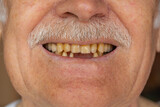 Close-up macro shot of toothless male smile mouth of senior elderly man. Dental problem, bad teeth loss. Pensioner grandfather showing rotten teeth, caries, decayed and weak enamel, teeth falling out