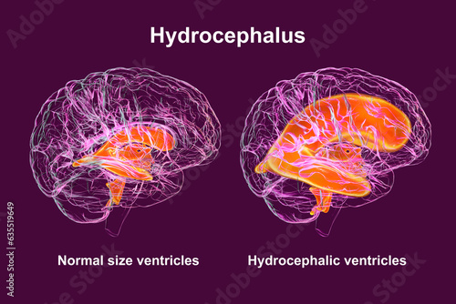 Enlarged ventricles of the child brain and normal ventricular system, 3D illustration