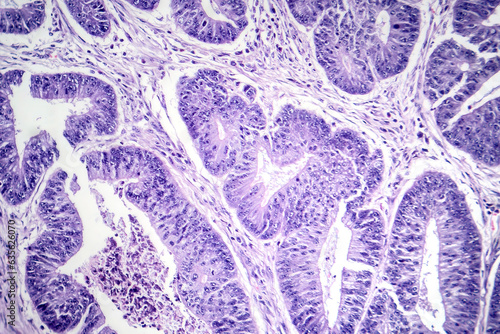 Foto Esophageal squamous cell carcinoma, light micrograph