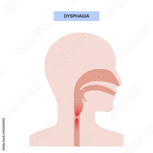 Dysphagia medical poster