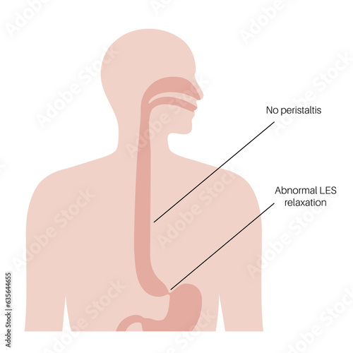 Esophageal achalasia disease
