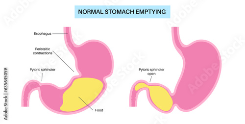 Gastroparesis anatomical poster