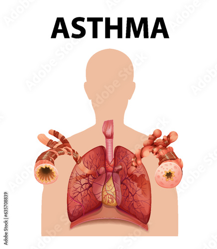 Comparing Normal and Asthma Lungs in Medical Education