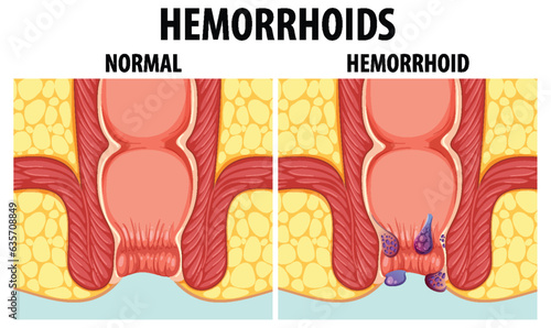 Comparing Normal and Internal Hemorrhoids in Human Anatomy