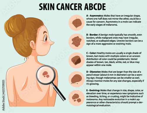 Skin Cancer: Abnormal Growth of Skin Cells Infographic