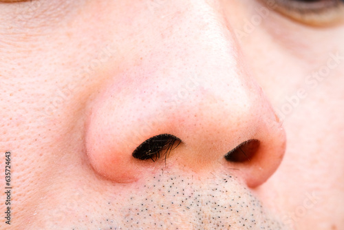 Young man's nose His nostrils are hairy. . Health and medical concepts photo