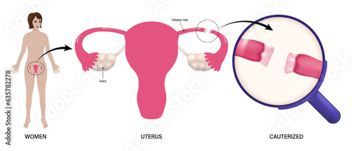 Women, uterus and Cauterized vector. Tubal ligation procedures. Female sterilization procedure. 