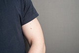 Hand of a man with moles on a gray background. Skin Cancer Awareness Month