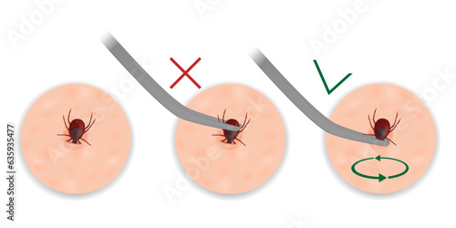 Instructions for removing a tick with tweezers. Extraction of mites. Tick removing. Vector illustration