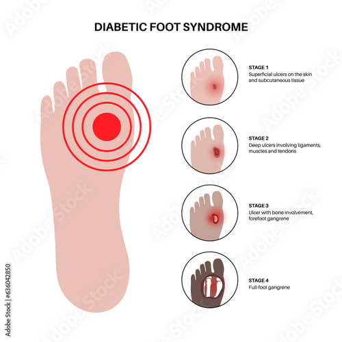 Diabetic Foot Ulcers