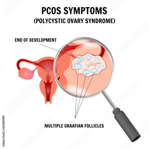 PCOS symptoms, polycystic ovary syndrome gynecology  illustration in vector