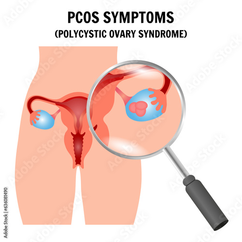 PCOS symptoms, polycystic ovary syndrome gynecology  illustration with zoom in vector