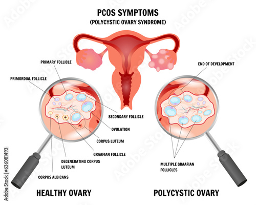 PCOS symptoms, polycystic ovary syndrome gynecology  infographic with zoom in vector