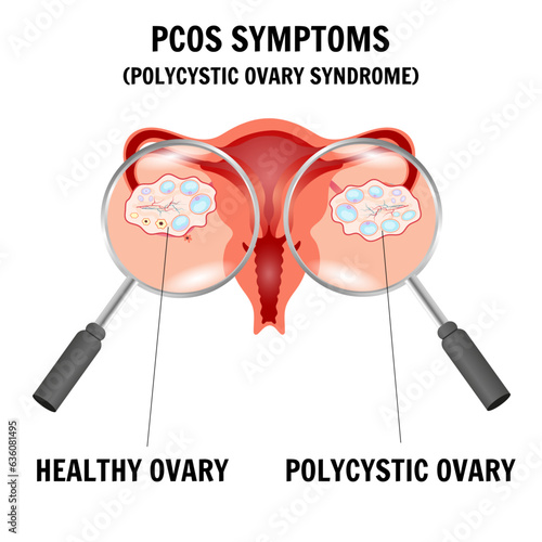 PCOS symptoms, polycystic ovary syndrome medical information  in vector